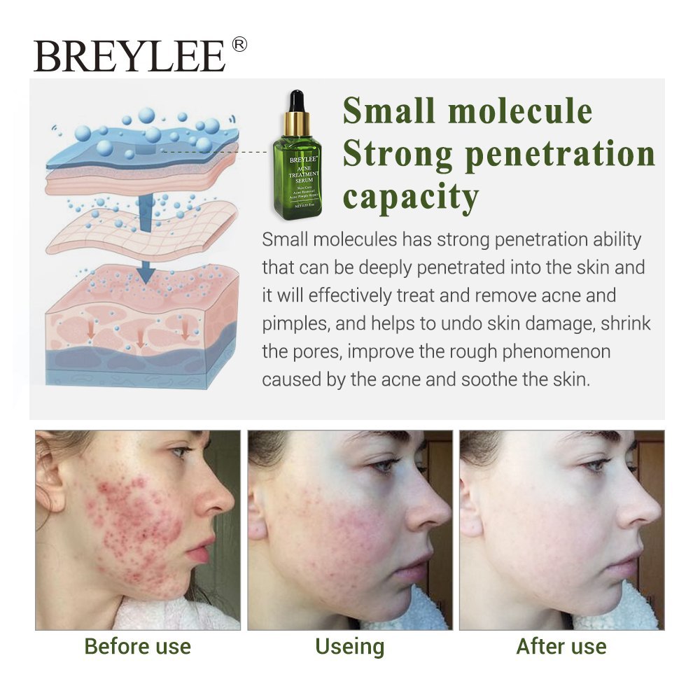 BREYLEE Acne Serum – Anti-Akne & Narbenpflege für klare Haut